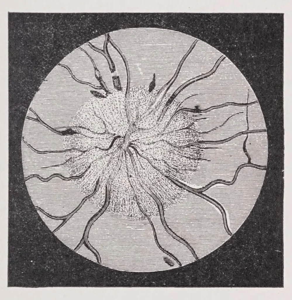 An illustration from Diseases of the eye, 1900, leaf 269