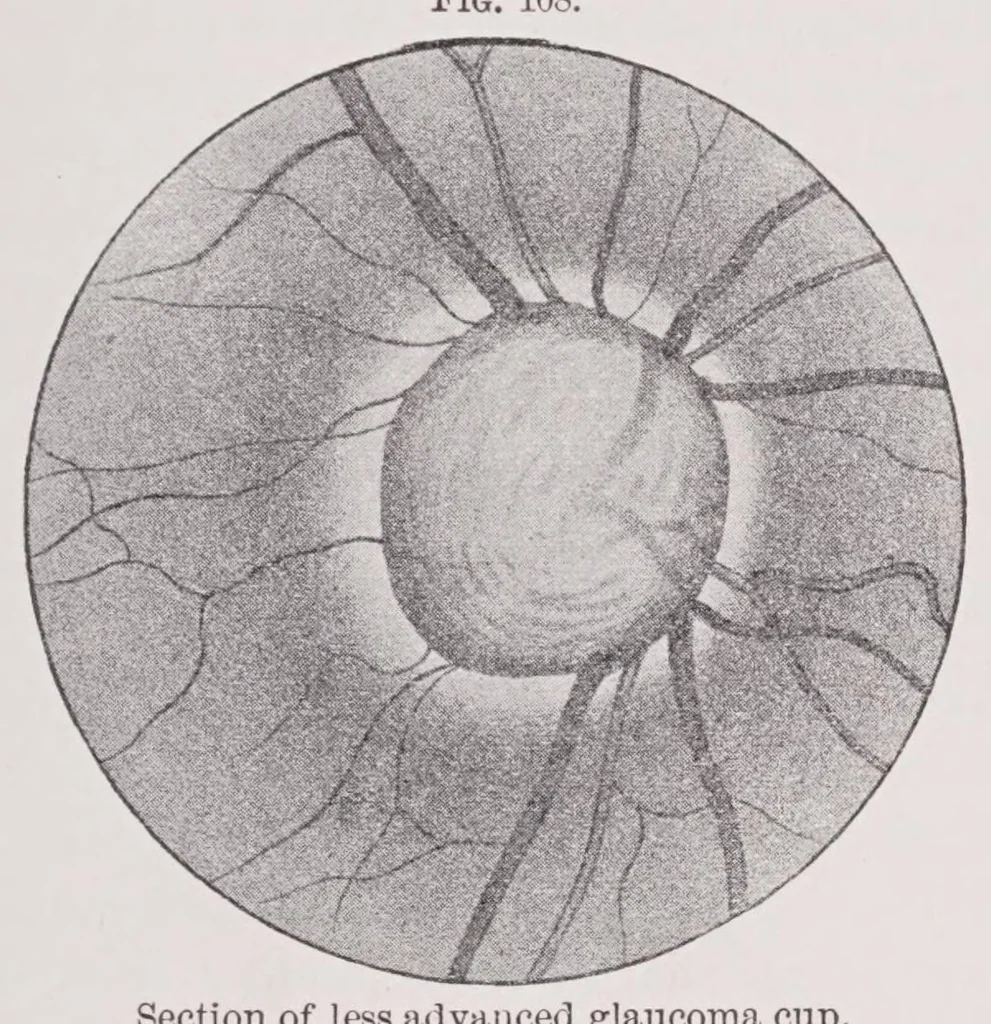An illustration from Diseases of the eye, 1900, leaf 309