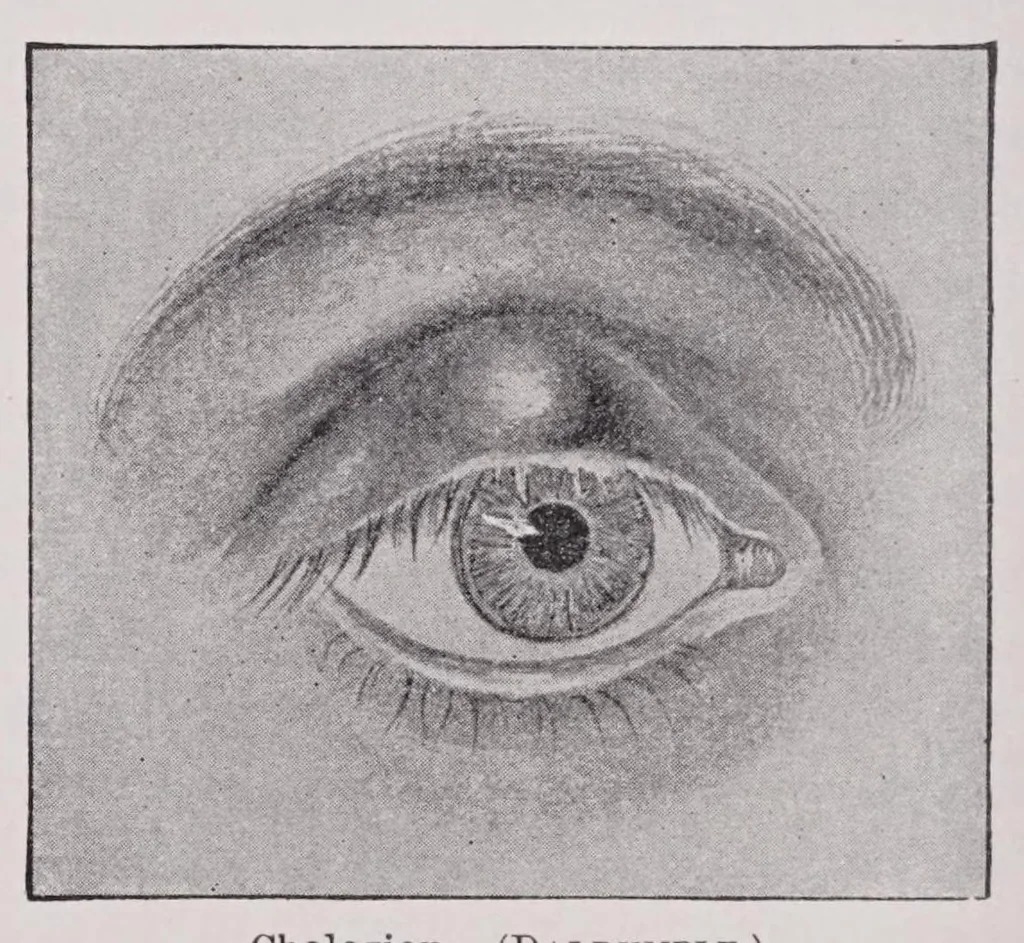 An illustration from Diseases of the eye, 1900, leaf 96