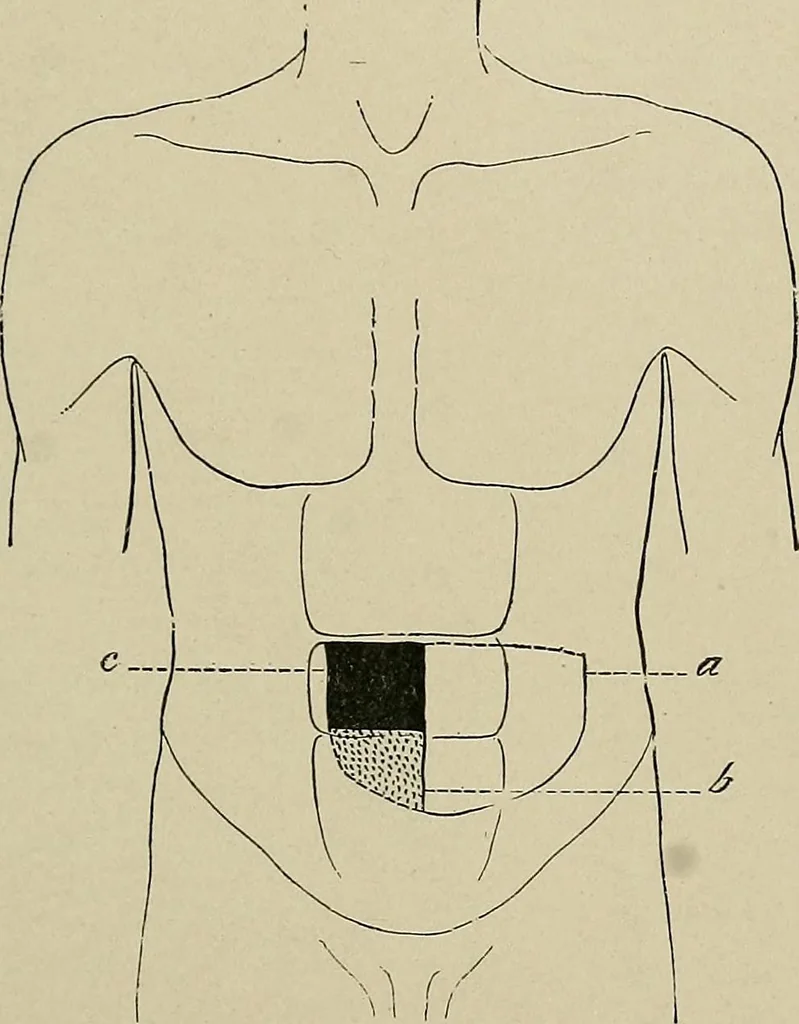 An illustration from Diseases of the stomach : a text-book for practitioners and students, 1906, leaf 435