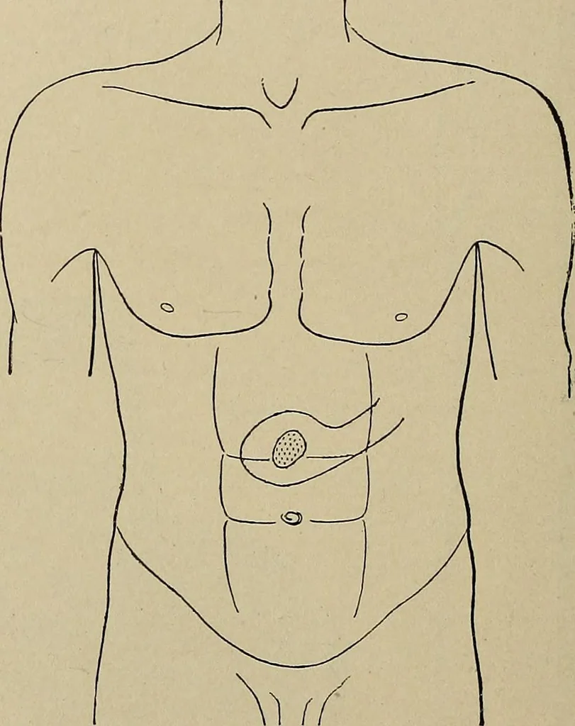 An illustration from Diseases of the stomach : a text-book for practitioners and students, 1906, leaf 68