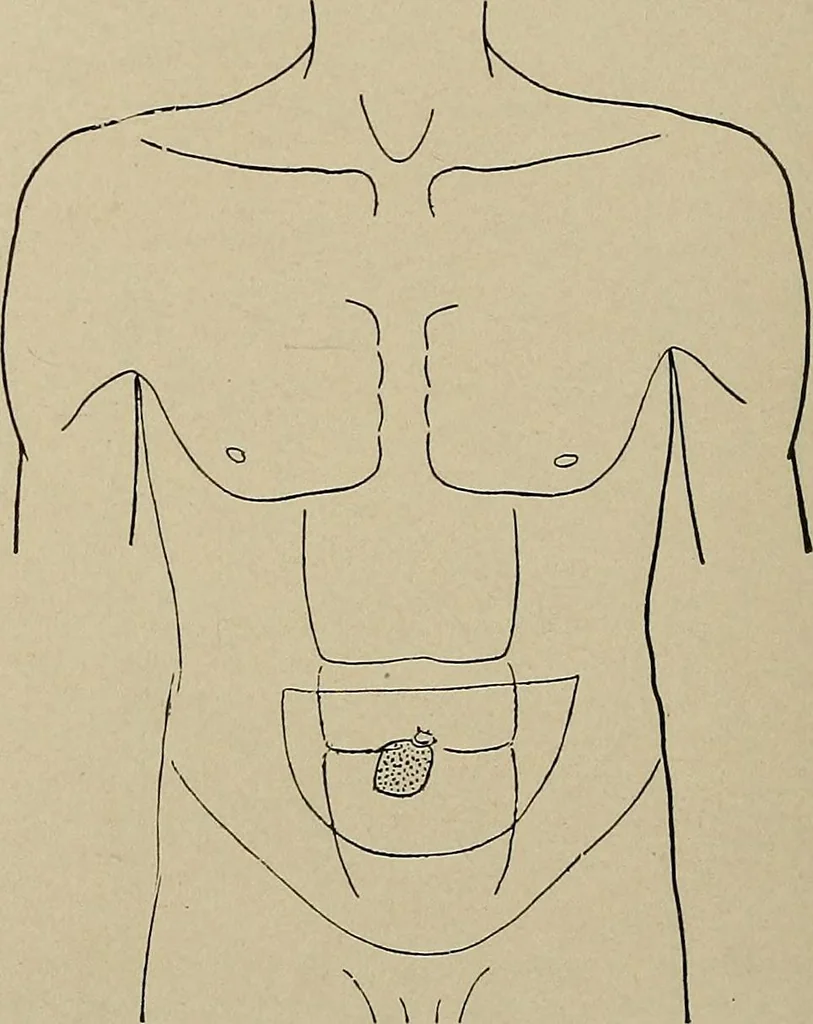 An illustration from Diseases of the stomach : a text-book for practitioners and students, 1906, leaf 70