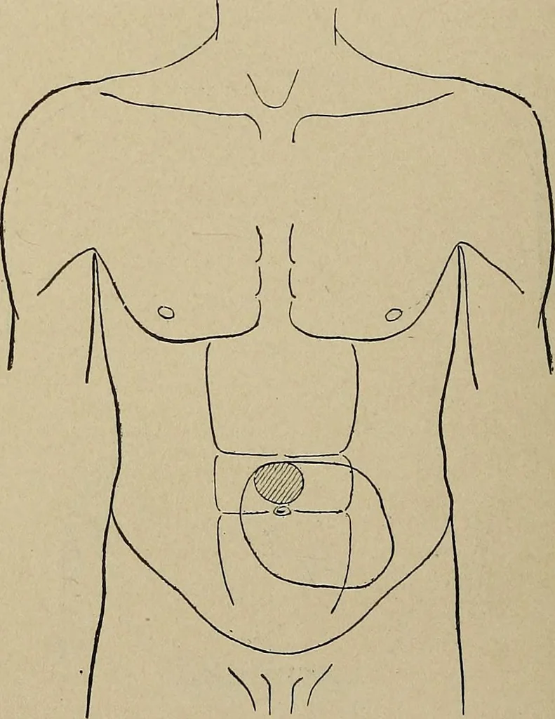 An illustration from Diseases of the stomach : a text-book for practitioners and students, 1906, leaf 72