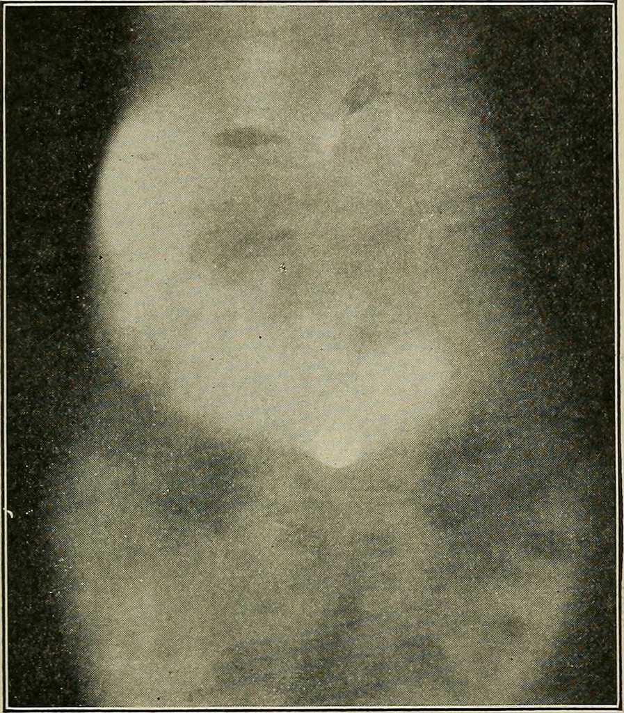 An illustration from Diseases of the stomach : a text-book for practitioners and students, 1906, leaf 73