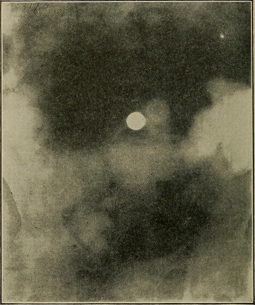 An illustration from Diseases of the stomach : a text-book for practitioners and students, 1906, leaf 76