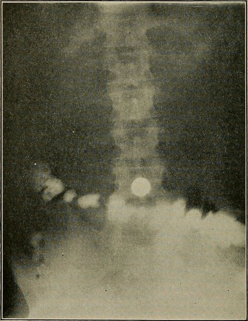 An illustration from Diseases of the stomach : a text-book for practitioners and students, 1906, leaf 78