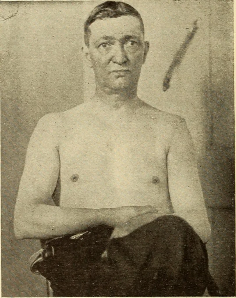 An illustration from Fractures and dislocations, diagnosis and treatment, 1915, leaf 103