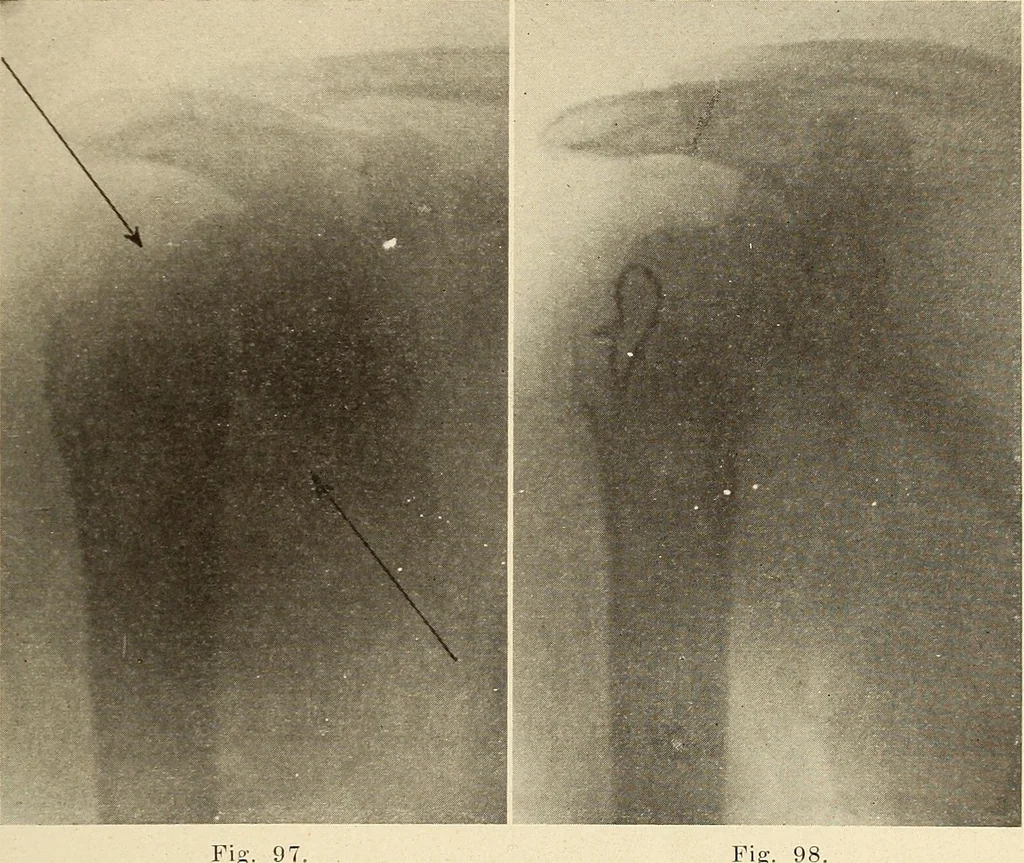 An illustration from Fractures and dislocations, diagnosis and treatment, 1915, leaf 104