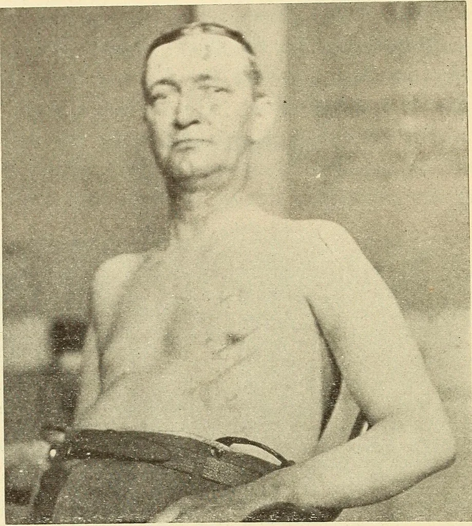 An illustration from Fractures and dislocations, diagnosis and treatment, 1915, leaf 105