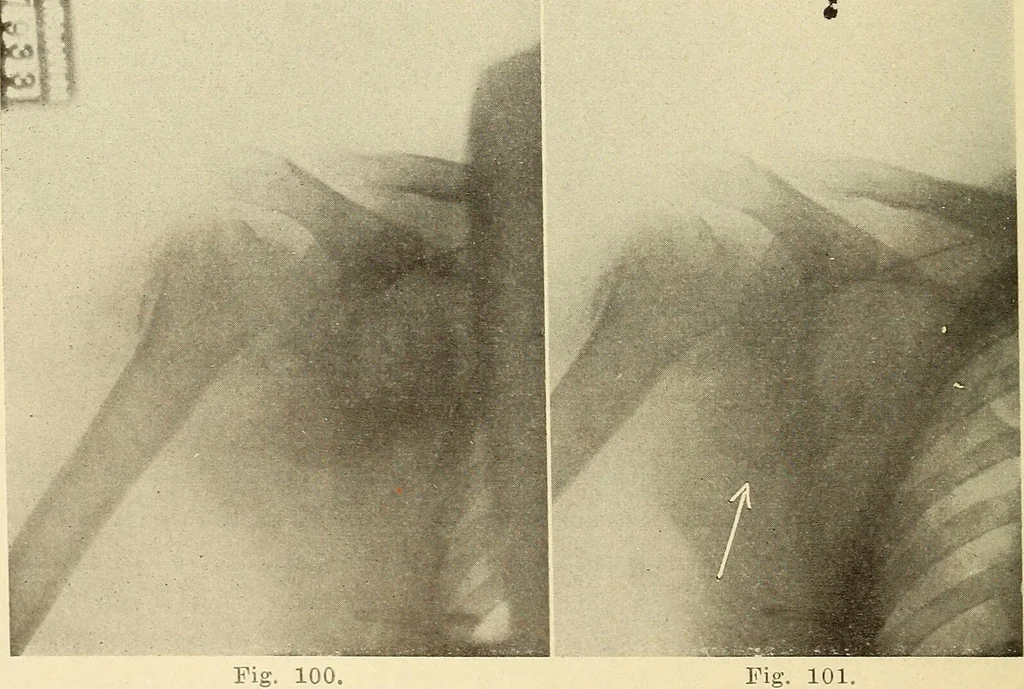 An illustration from Fractures and dislocations, diagnosis and treatment, 1915, leaf 105