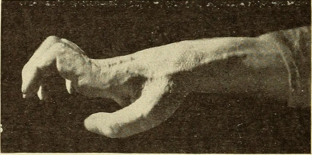 An illustration from Fractures and dislocations, diagnosis and treatment, 1915, leaf 107