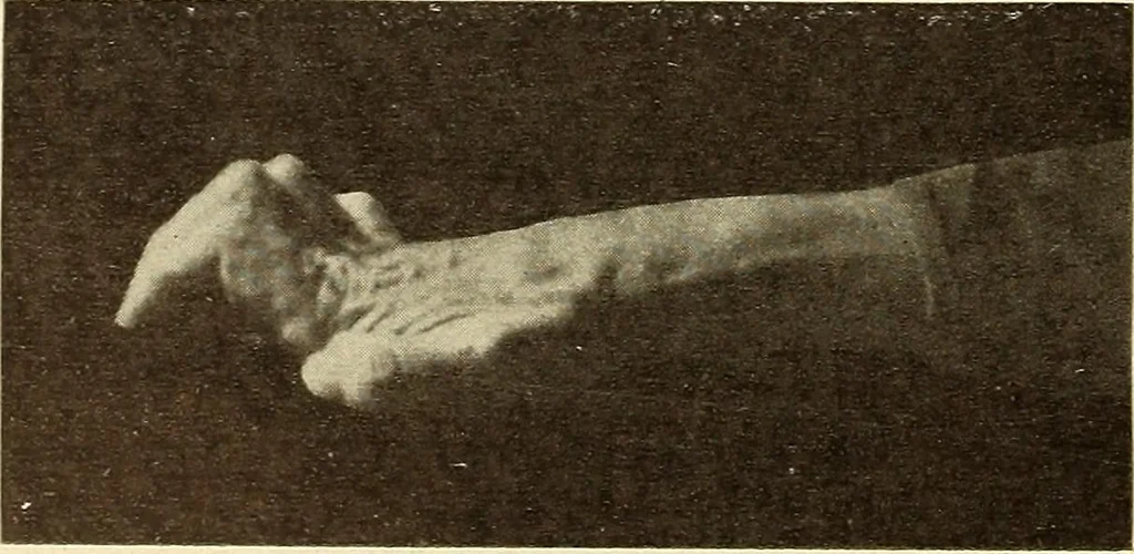 An illustration from Fractures and dislocations, diagnosis and treatment, 1915, leaf 107