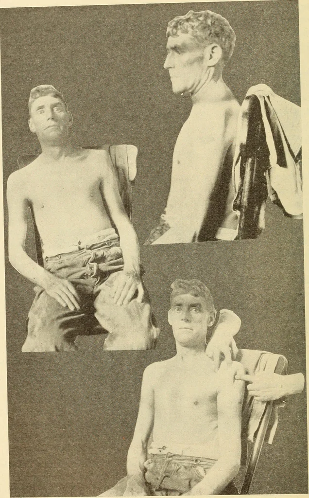 An illustration from Fractures and dislocations, diagnosis and treatment, 1915, leaf 109