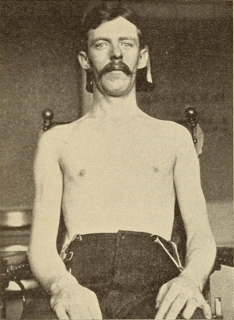 An illustration from Fractures and dislocations, diagnosis and treatment, 1915, leaf 110