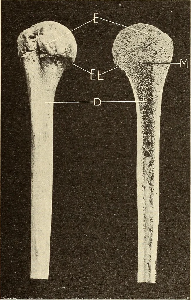 An illustration from Fractures and dislocations, diagnosis and treatment, 1915, leaf 114