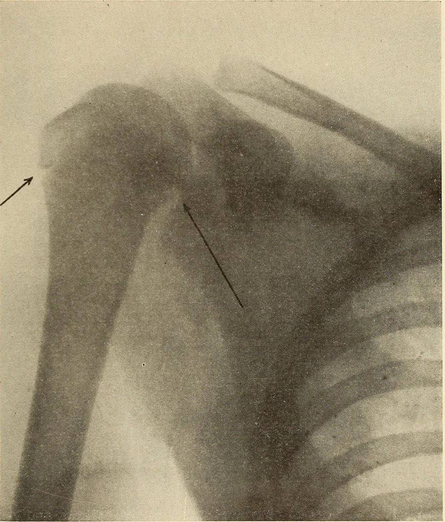 An illustration from Fractures and dislocations, diagnosis and treatment, 1915, leaf 116