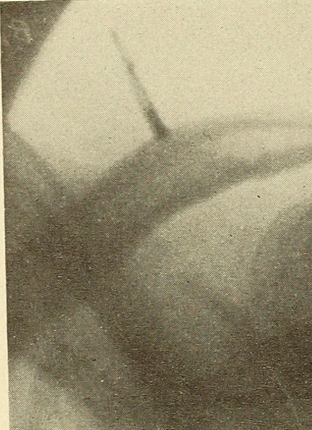 An illustration from Fractures and dislocations, diagnosis and treatment, 1915, leaf 117