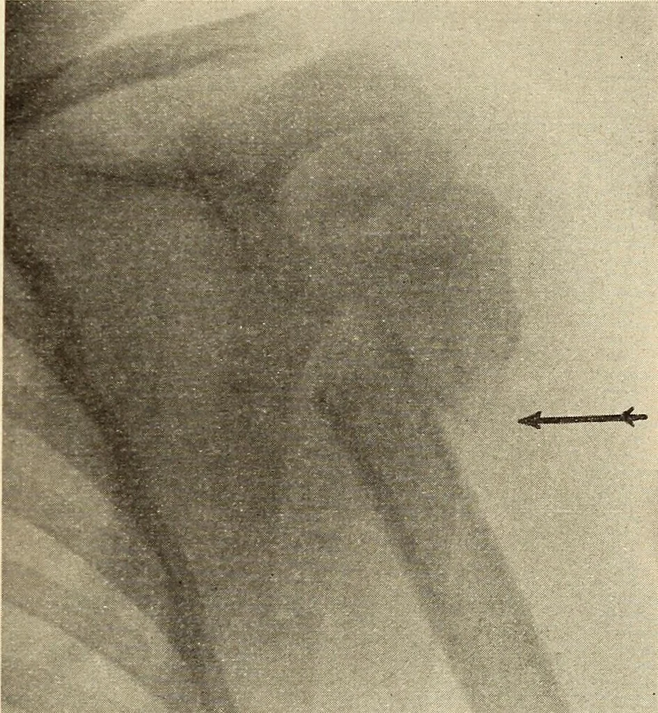 An illustration from Fractures and dislocations, diagnosis and treatment, 1915, leaf 120