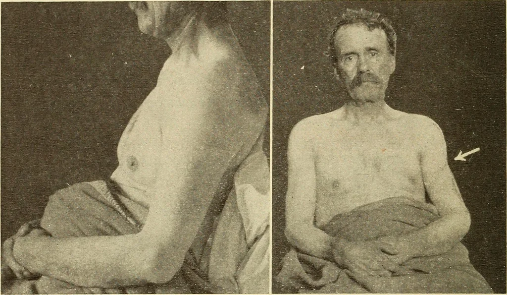 An illustration from Fractures and dislocations, diagnosis and treatment, 1915, leaf 121