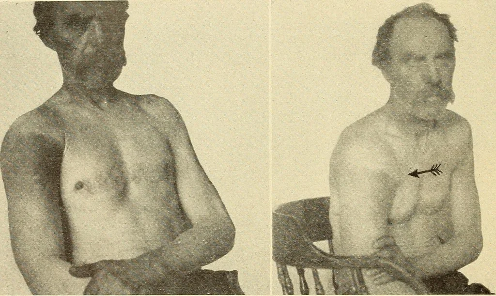 An illustration from Fractures and dislocations, diagnosis and treatment, 1915, leaf 123