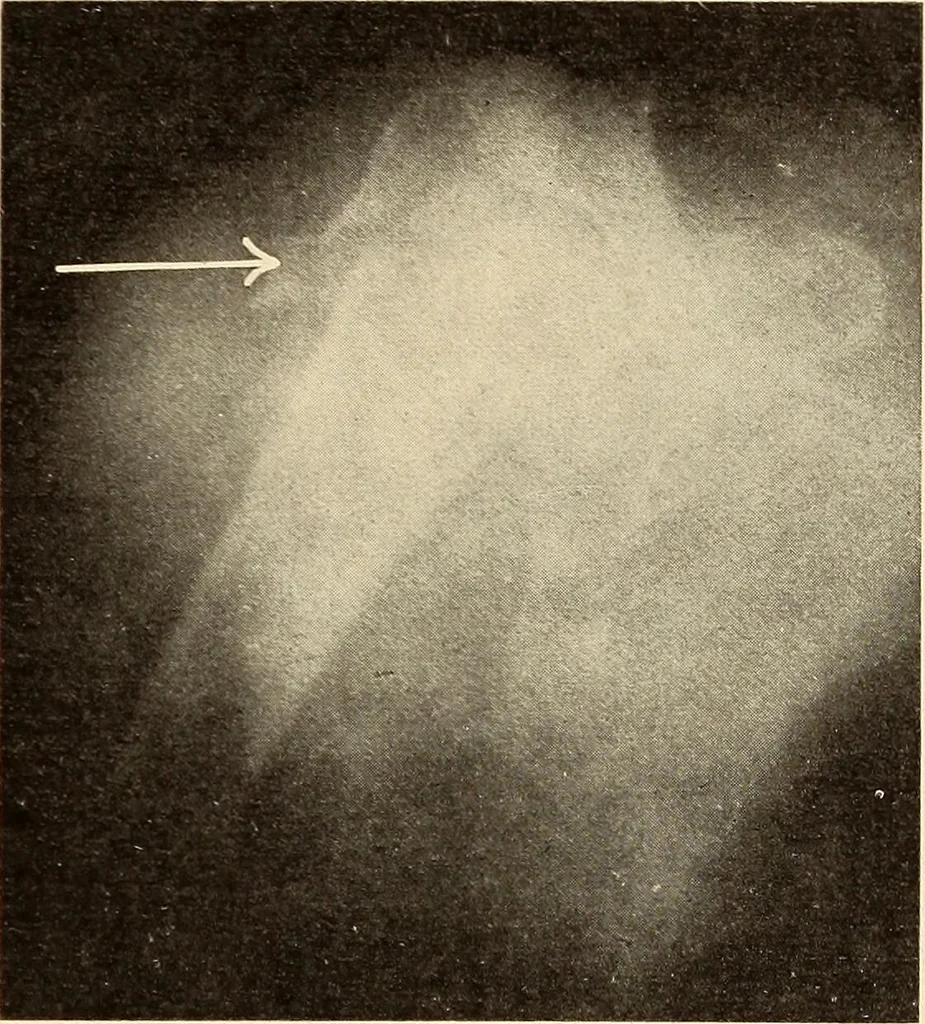 An illustration from Fractures and dislocations, diagnosis and treatment, 1915, leaf 124