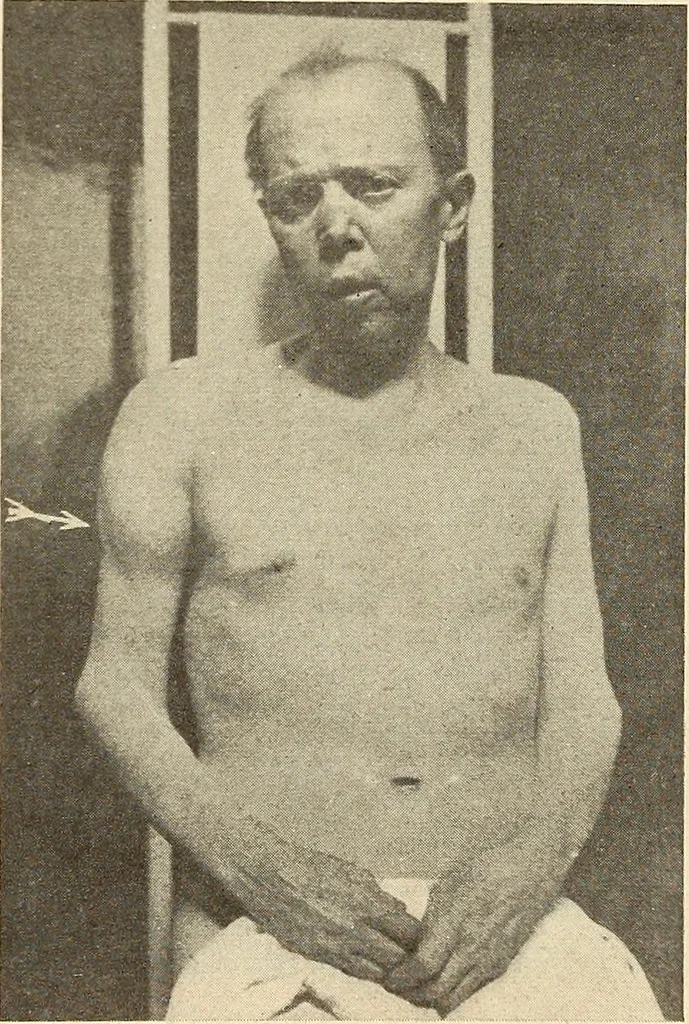 An illustration from Fractures and dislocations, diagnosis and treatment, 1915, leaf 124