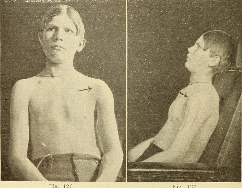 An illustration from Fractures and dislocations, diagnosis and treatment, 1915, leaf 125