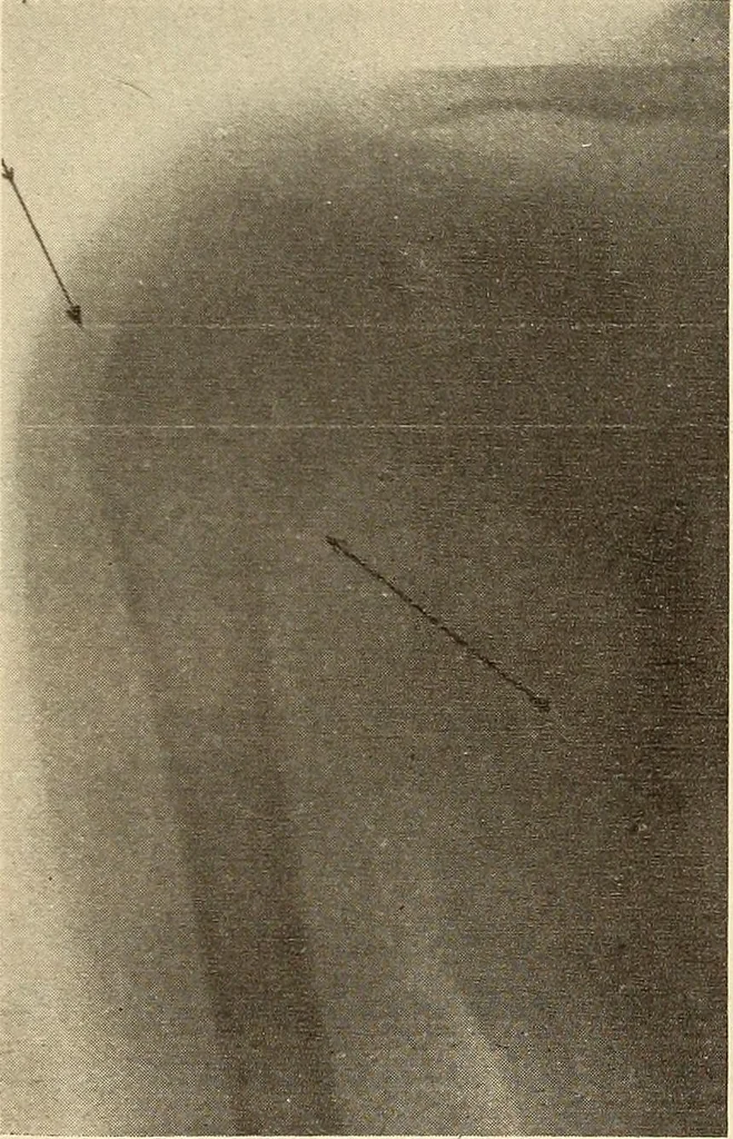 An illustration from Fractures and dislocations, diagnosis and treatment, 1915, leaf 126
