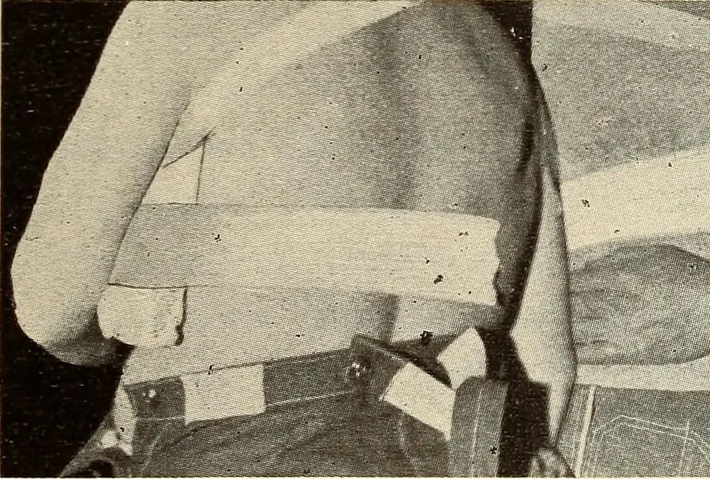 An illustration from Fractures and dislocations, diagnosis and treatment, 1915, leaf 130