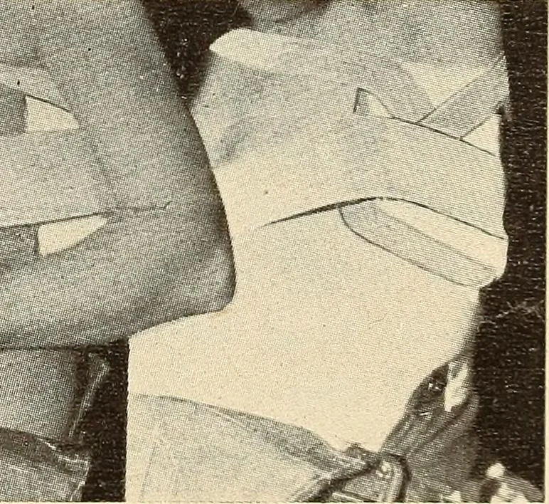 An illustration from Fractures and dislocations, diagnosis and treatment, 1915, leaf 130
