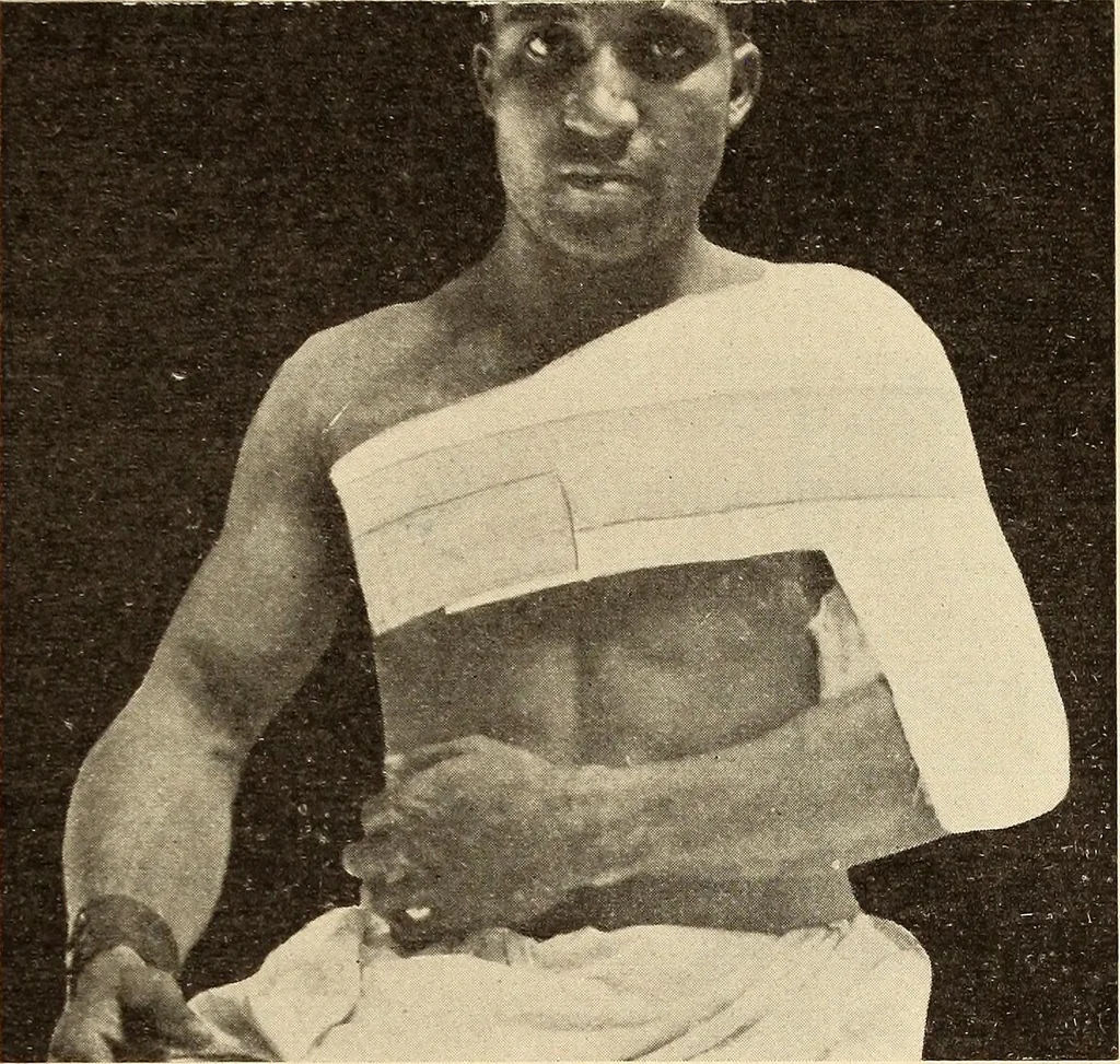An illustration from Fractures and dislocations, diagnosis and treatment, 1915, leaf 132