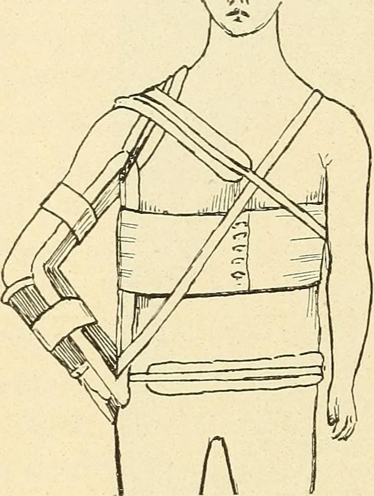 An illustration from Fractures and dislocations, diagnosis and treatment, 1915, leaf 133