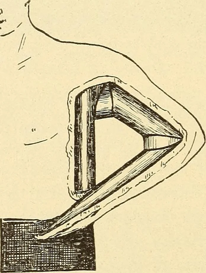 An illustration from Fractures and dislocations, diagnosis and treatment, 1915, leaf 133