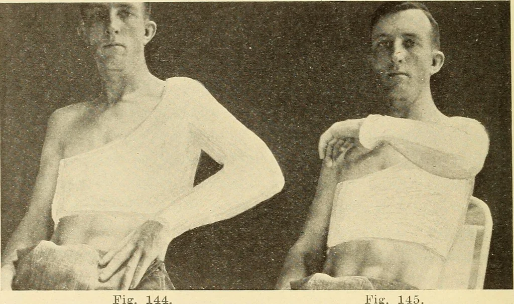 An illustration from Fractures and dislocations, diagnosis and treatment, 1915, leaf 135