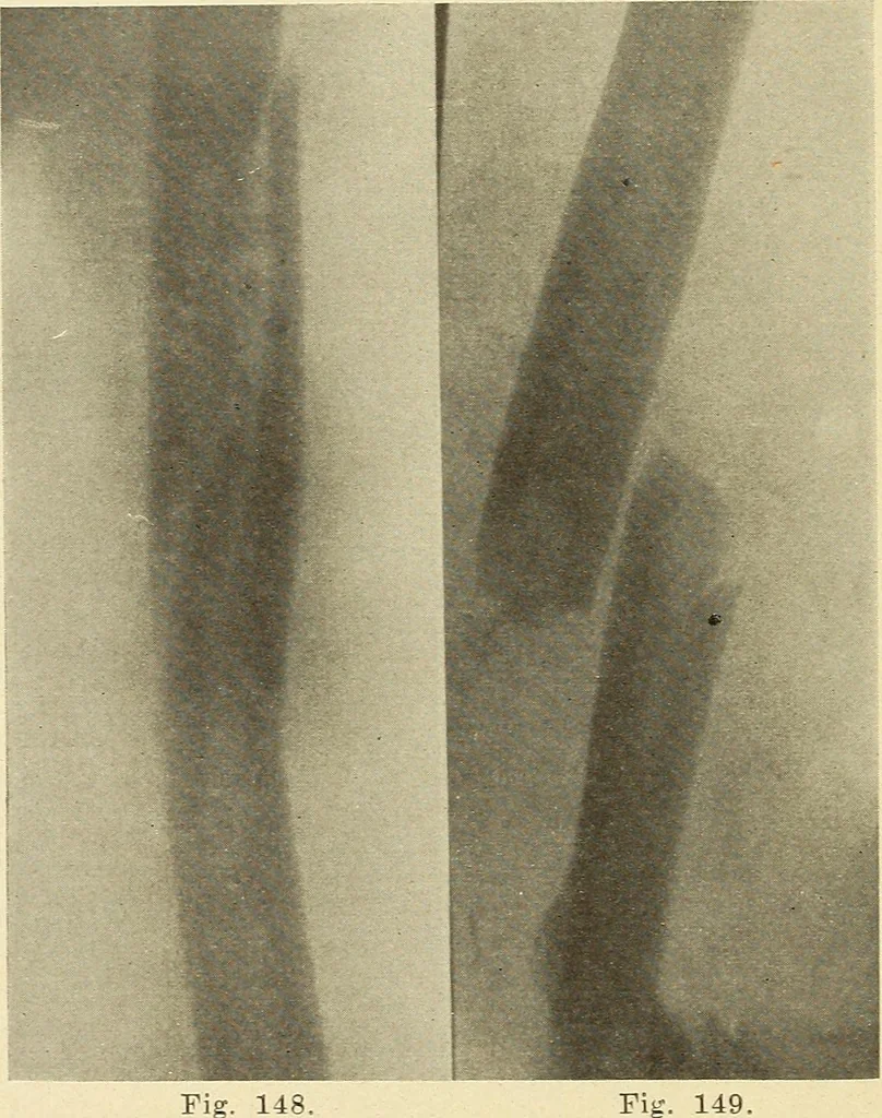 An illustration from Fractures and dislocations, diagnosis and treatment, 1915, leaf 141