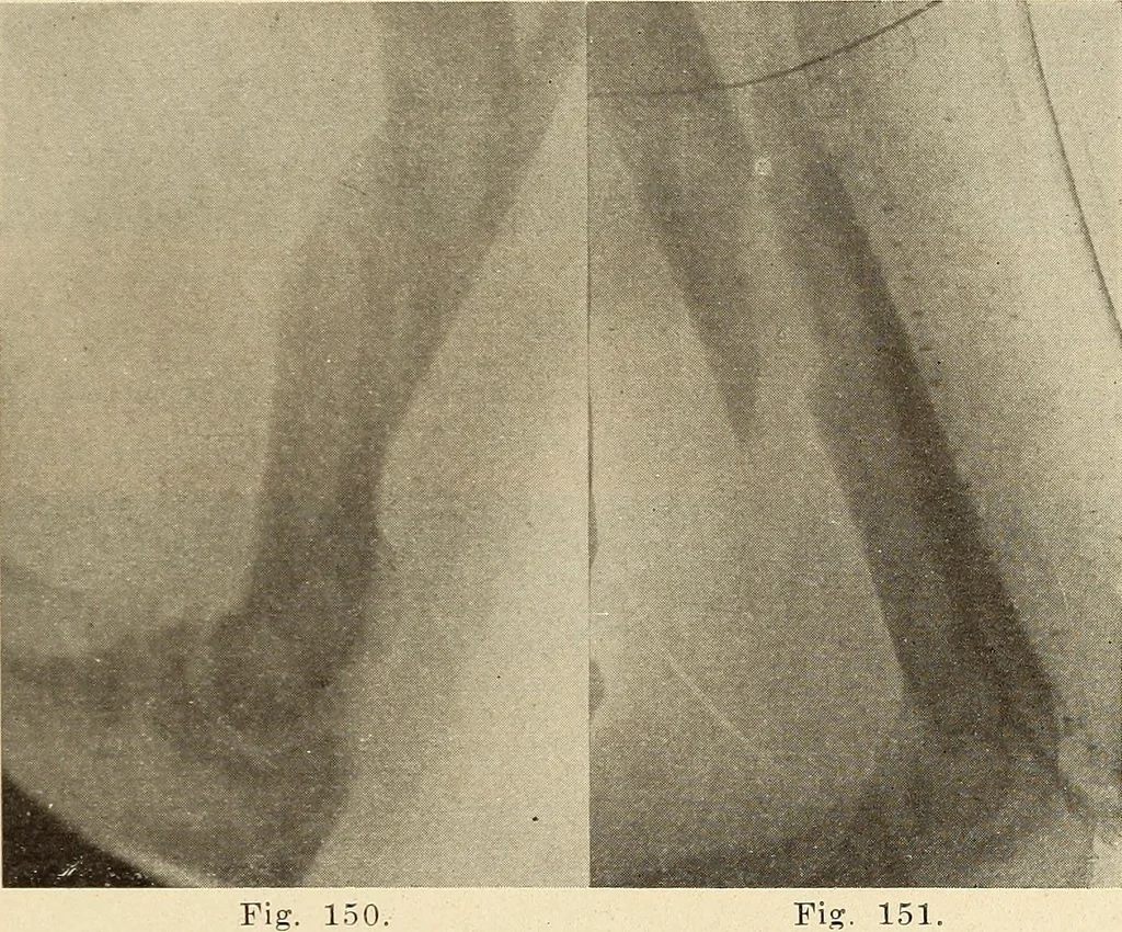 An illustration from Fractures and dislocations, diagnosis and treatment, 1915, leaf 142