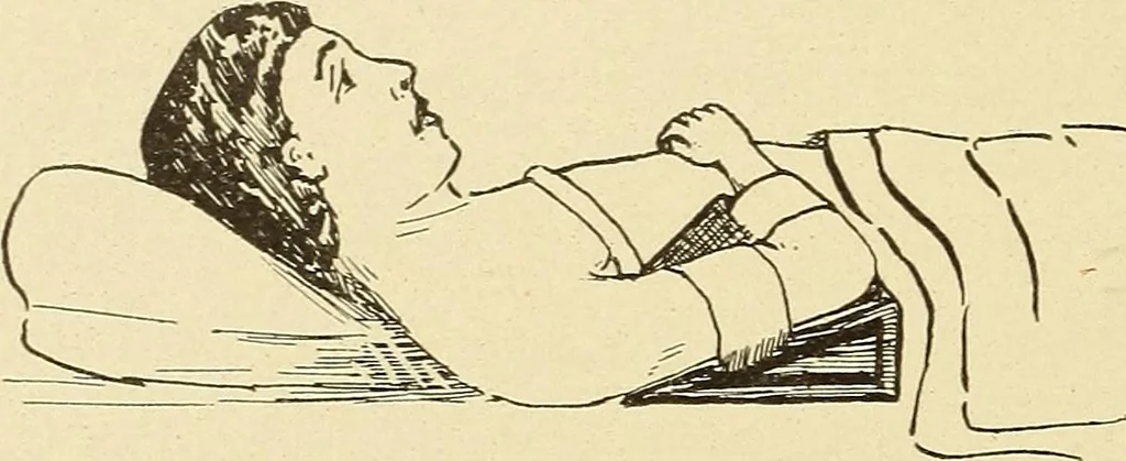 An illustration from Fractures and dislocations, diagnosis and treatment, 1915, leaf 145
