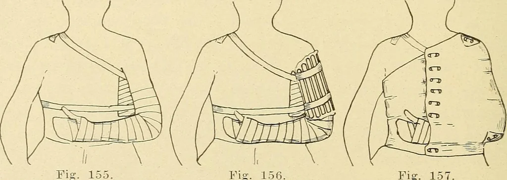 An illustration from Fractures and dislocations, diagnosis and treatment, 1915, leaf 145
