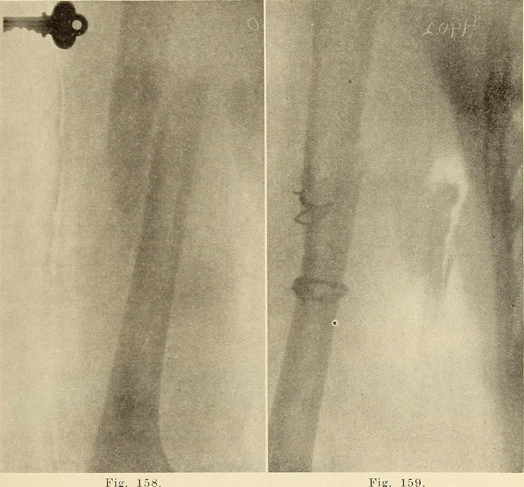 An illustration from Fractures and dislocations, diagnosis and treatment, 1915, leaf 148