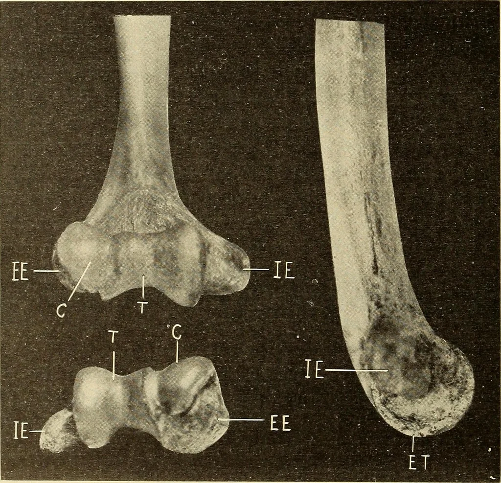 An illustration from Fractures and dislocations, diagnosis and treatment, 1915, leaf 151