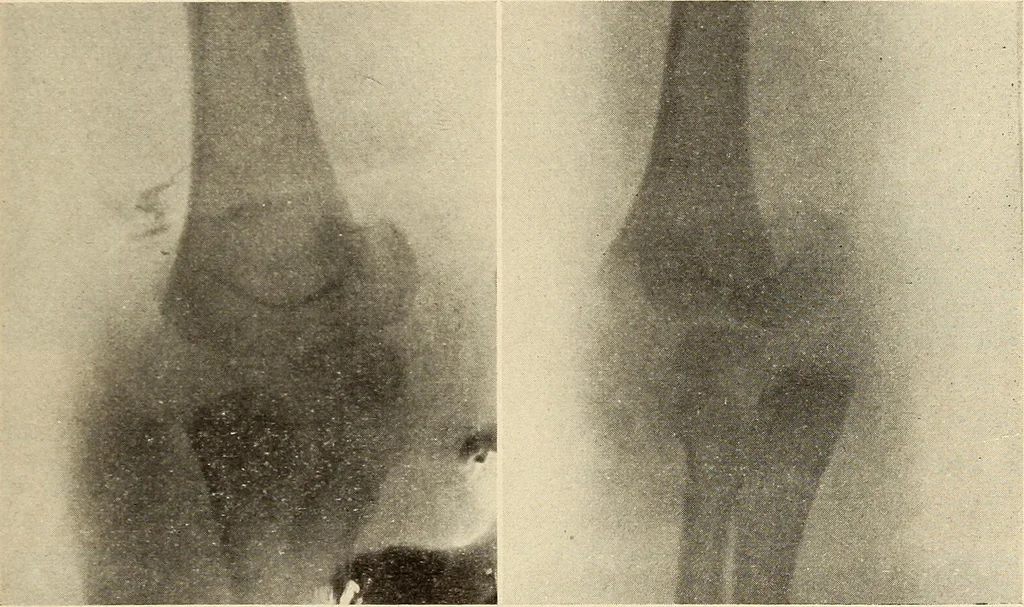 An illustration from Fractures and dislocations, diagnosis and treatment, 1915, leaf 152