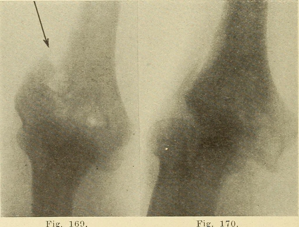 An illustration from Fractures and dislocations, diagnosis and treatment, 1915, leaf 153
