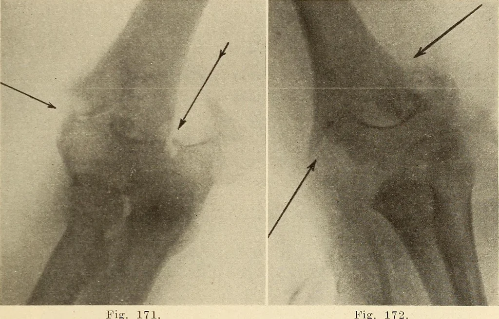 An illustration from Fractures and dislocations, diagnosis and treatment, 1915, leaf 154