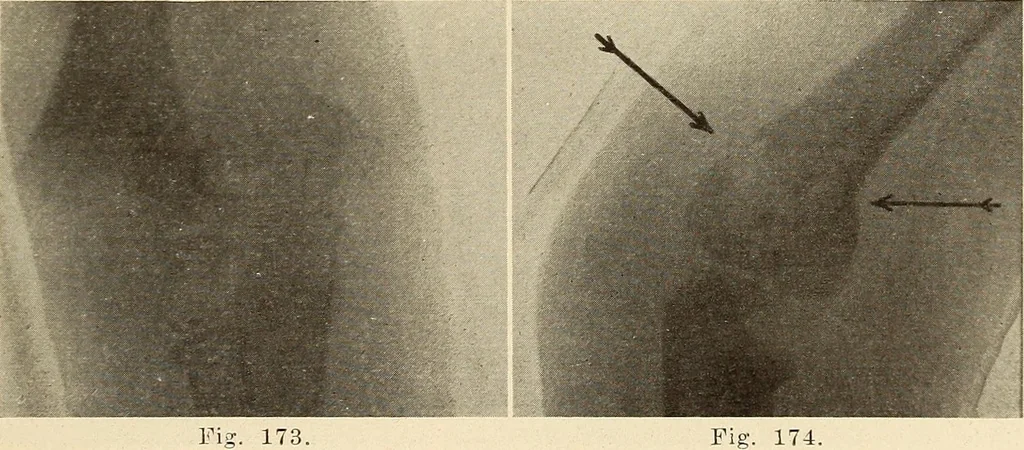 An illustration from Fractures and dislocations, diagnosis and treatment, 1915, leaf 154