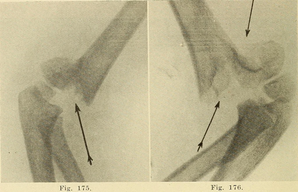 An illustration from Fractures and dislocations, diagnosis and treatment, 1915, leaf 155