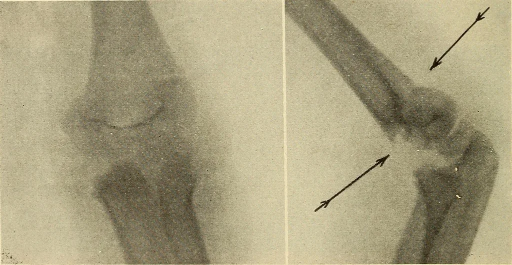 An illustration from Fractures and dislocations, diagnosis and treatment, 1915, leaf 155