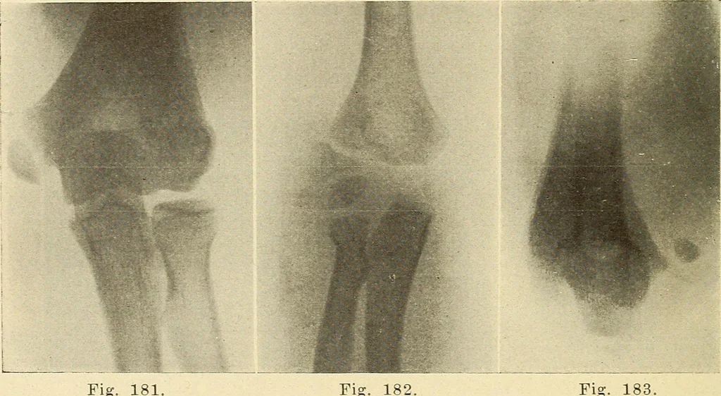 An illustration from Fractures and dislocations, diagnosis and treatment, 1915, leaf 157