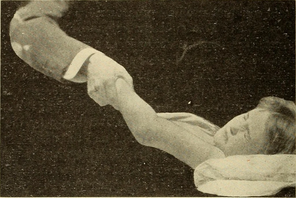 An illustration from Fractures and dislocations, diagnosis and treatment, 1915, leaf 163