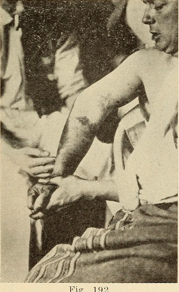 An illustration from Fractures and dislocations, diagnosis and treatment, 1915, leaf 164