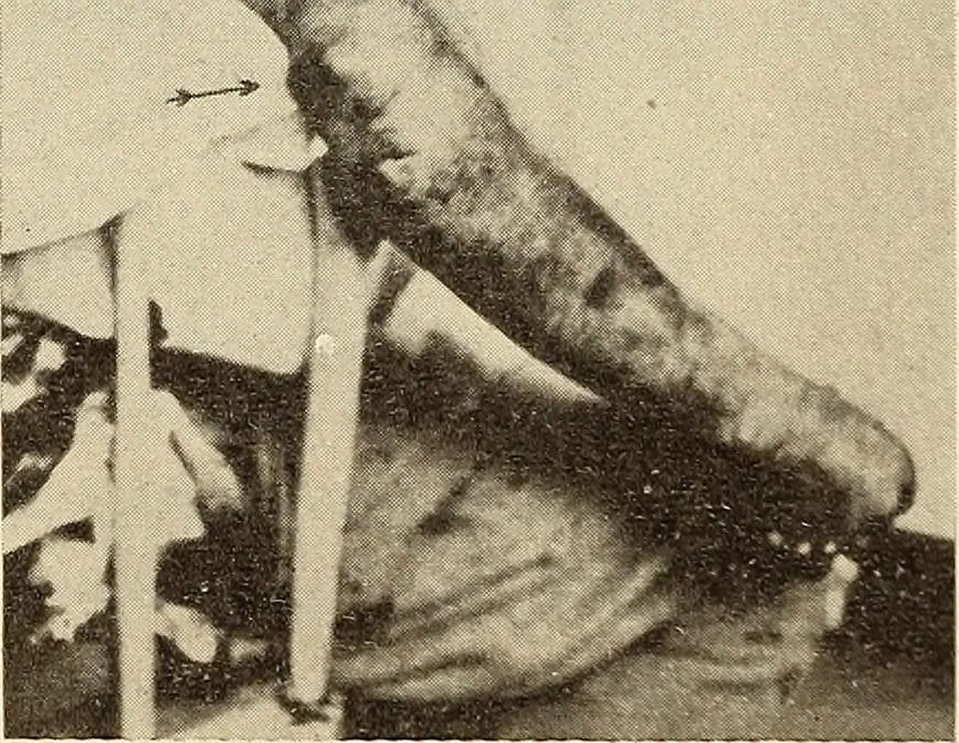 An illustration from Fractures and dislocations, diagnosis and treatment, 1915, leaf 164